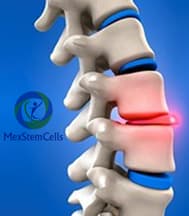 Slider image (10) MexStemCells Clinic for Chronic Degenerative Wellness